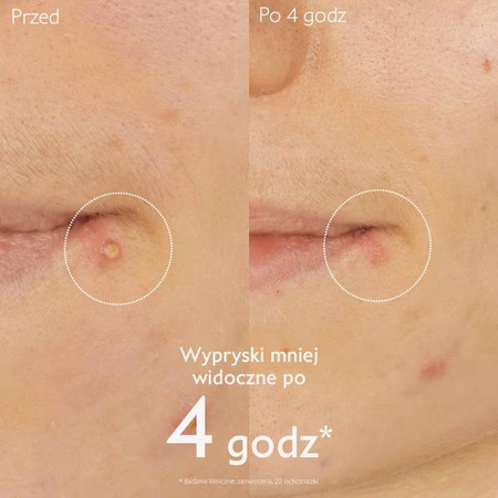 Caudalie Vinopure Punktowa Kuracja Przeciwtrądzikowa, 15ml